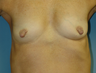 Nipple Reduction