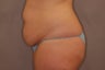Tummy Tuck