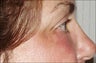 Side-view brow lift patient