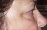 Side-view brow lift patient