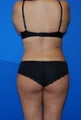 Upper / lower back and flank liposuction