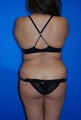 Upper / lower back and flank liposuction