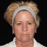 Female patient with aging skin.