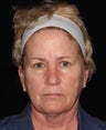 Female patient with aging skin.