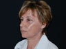 Facelift