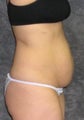 Tummy Tuck