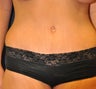 Tummy Tuck
