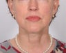 Face and neck lift
