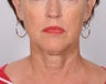 Face and neck lift