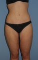 29 y/o woman with massive weight loss treated with body contouring surgery.