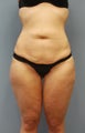 29 y/o woman with massive weight loss treated with body contouring surgery.