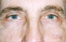 Blepharoplasty 