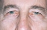 Blepharoplasty 