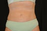 CoolSculpting