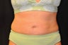 CoolSculpting