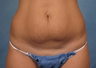 Tummy Tuck
