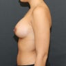Breast Augmentation