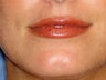 Before lip filler