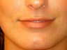 Before lip filler