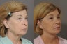 Facelift