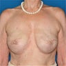 Bilateral Breast Reconstruction after Mastectomy