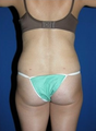 Liposuction