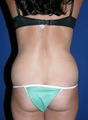 Liposuction