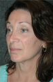 Eyelid Surgery