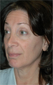 Eyelid Surgery