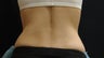 Coolsculpting