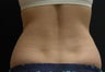 Coolsculpting