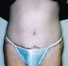 Female patient who underwent surgery for major weight loss 