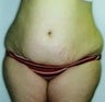 Female patient who underwent surgery for major weight loss 