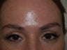 Eyebrow Hair Transplant