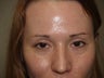 Eyebrow Hair Transplant