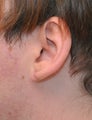 Closure of Stretched (gauged) ear lobe piercings