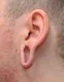 Closure of Stretched (gauged) ear lobe piercings