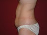 Liposuction