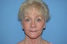 Facelift with Fat Transfer