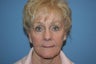Facelift with Fat Transfer