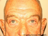 Eyelid Surgery