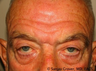 Eyelid Surgery