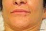 lip lift