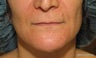 lip lift
