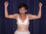 Brachioplasty