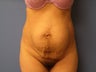 35 yo female with severe loss of abdominal muscles