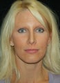 Revision Rhinoplasty