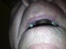 75 yo male with hemangioma upper lip