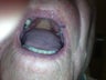 75 yo male with hemangioma upper lip