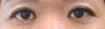 Bilateral Asian Eyelid Surgery